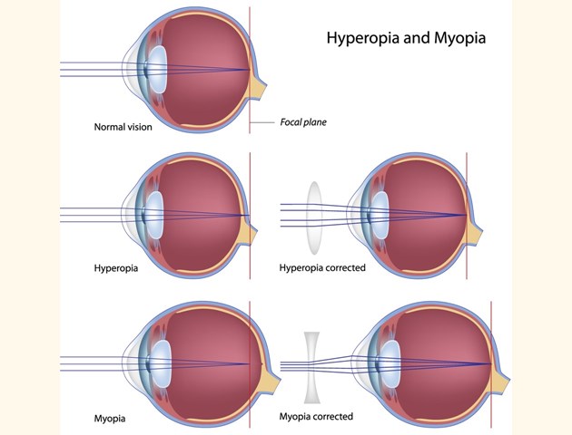 a rövidlátás myopia vagy hyperopia)