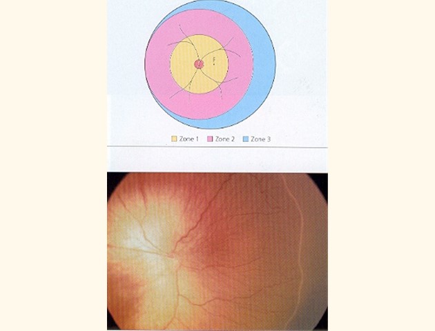 Prematuren retinopathie