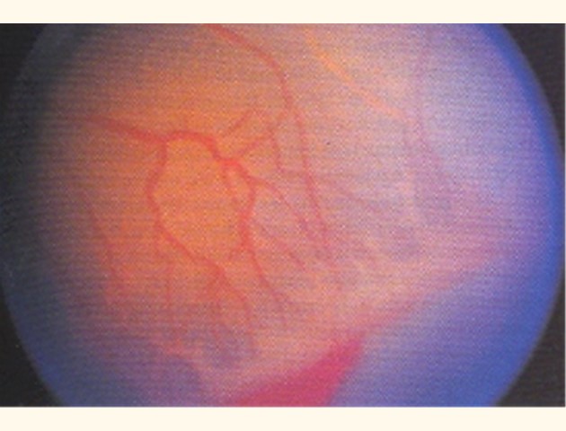 Prematuren retinopathie