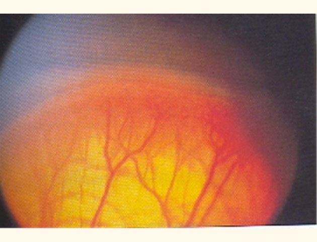 Prematuren retinopathie