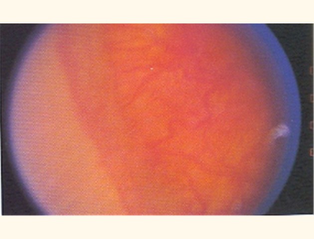 Prematuren retinopathie