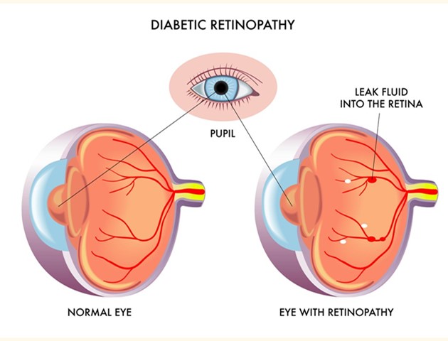 Prematuren retinopathie