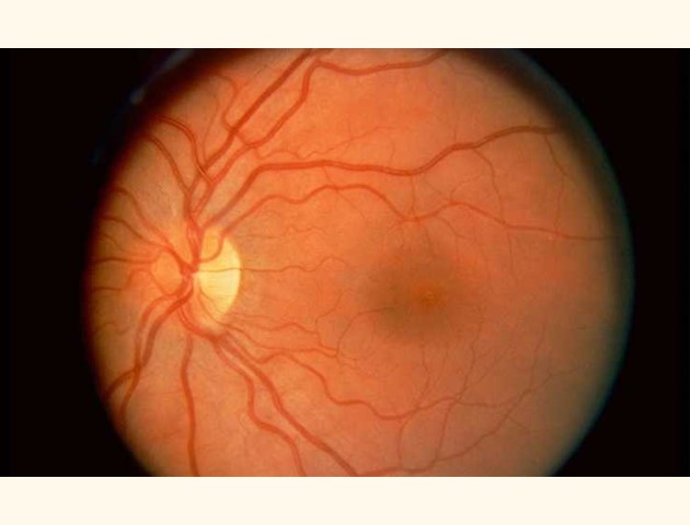 Prematuren retinopathie