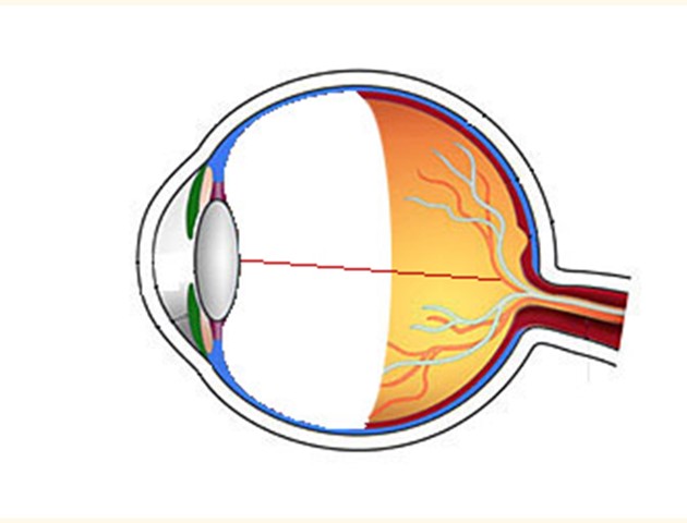 Prematuren retinopathie